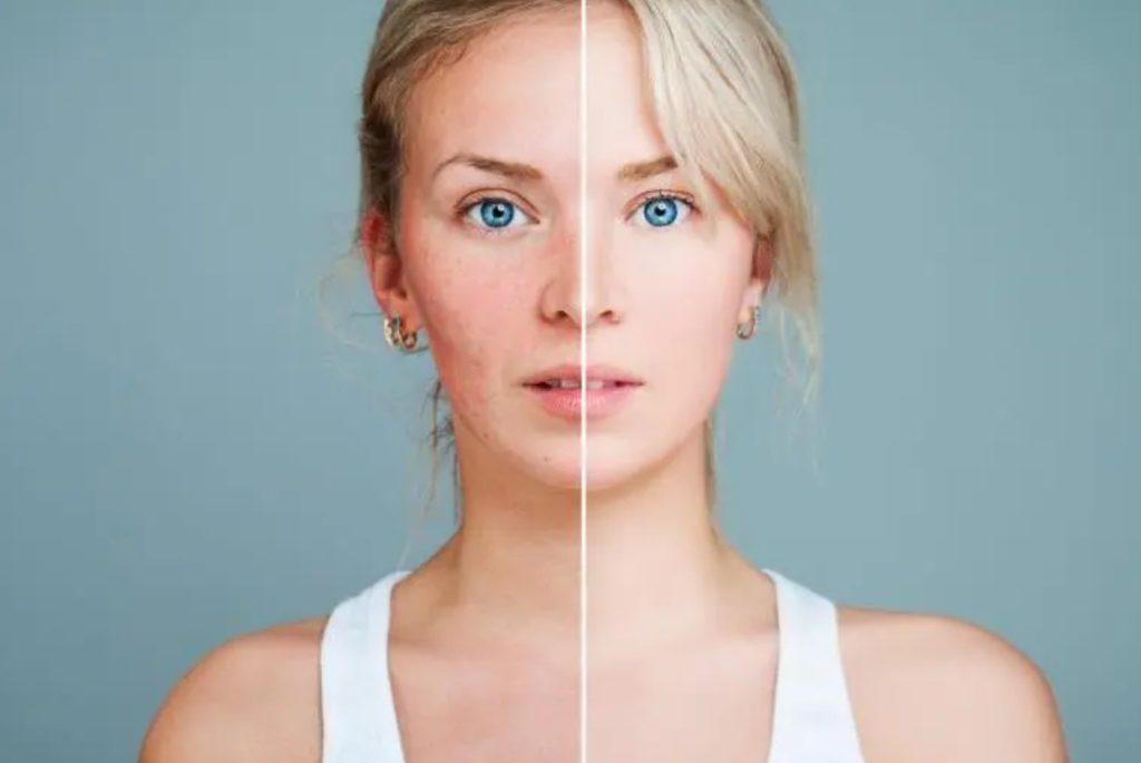 How does a woman light spot, dispel acne